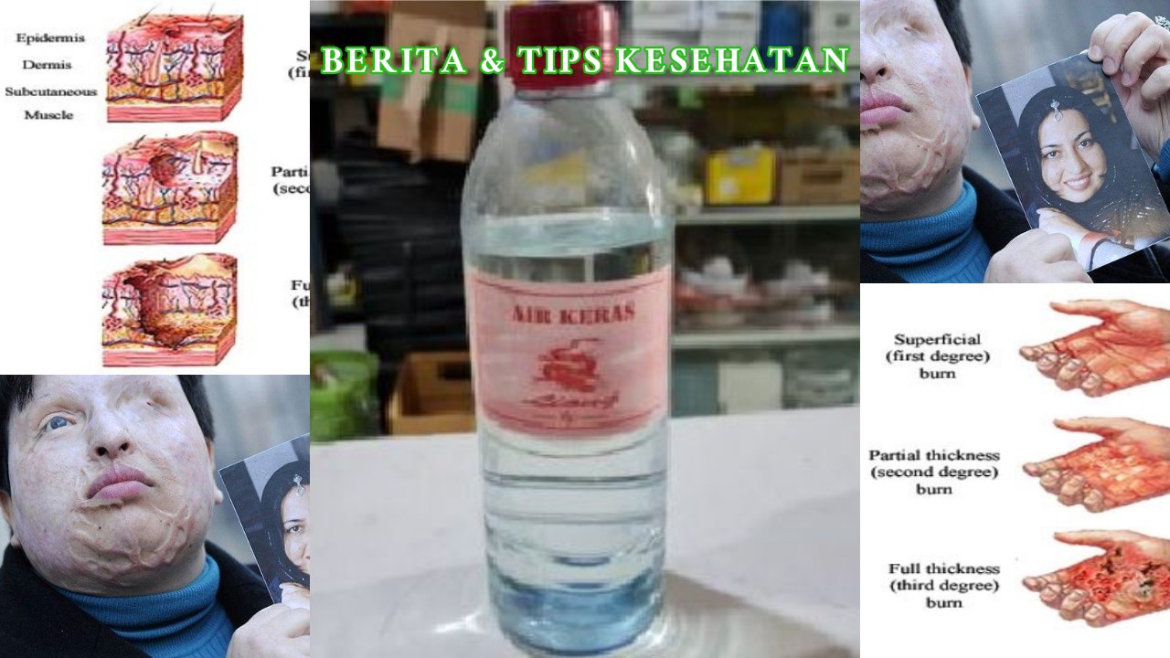 Air Keras Zat Korosif yang Bisa Lukai dan Bahayakan Tubuh