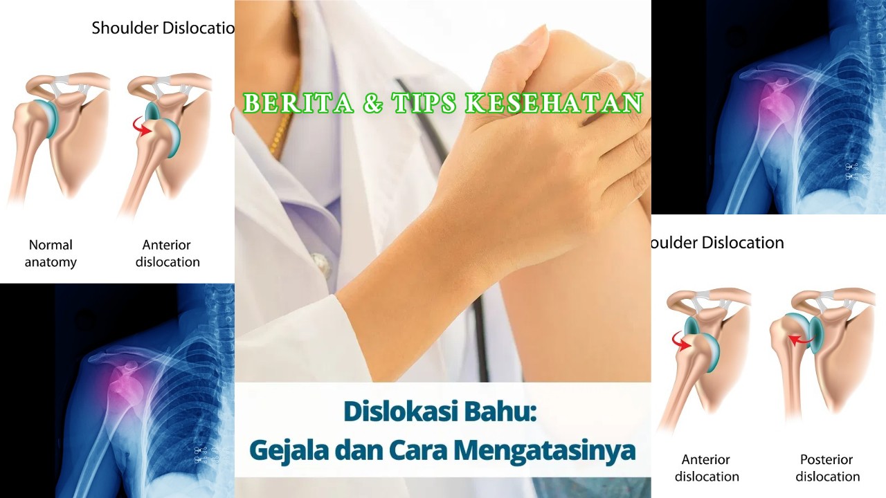 Dislokasi Bahu Penyebab, Gejala, dan Cara Mencegah Cedera