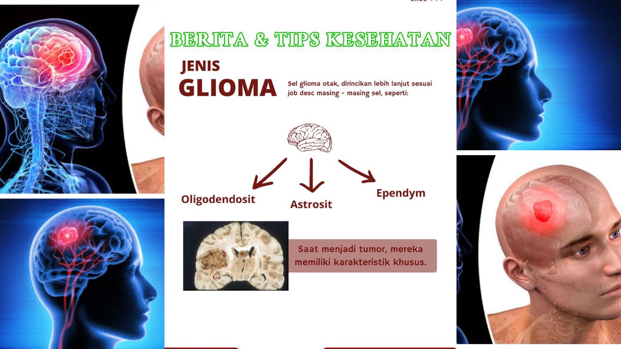 Mengenal Glioma Jenis, Ciri, dan Dampaknya pada Kesehatan