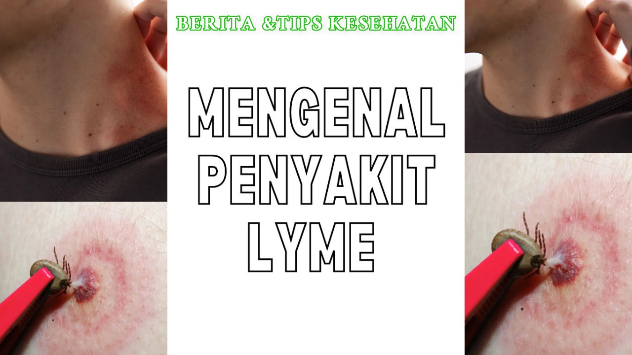 Sejarah Penyakit Lyme Dari Gigitan Kutu ke Infeksi Serius