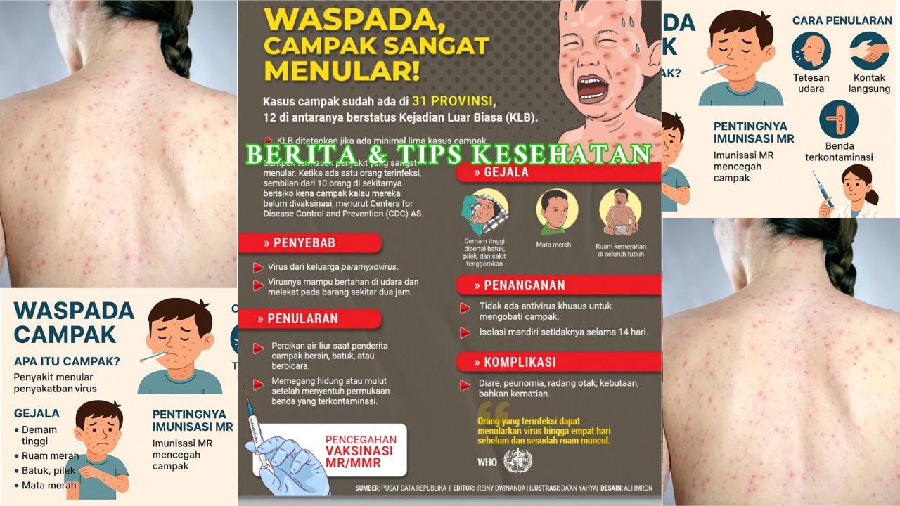 Waspada Lonjakan Kasus Campak, Ini Gejala dan Penanganannya