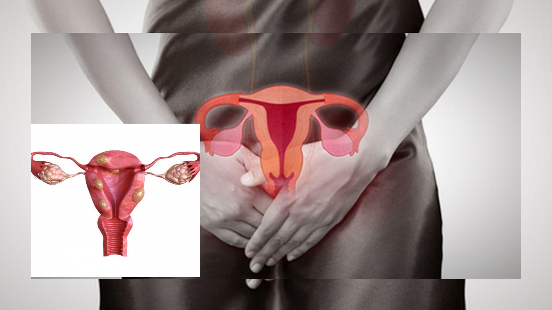 Kenali 6 Gangguan Rahim yang Dapat Menghambat Kehamilan