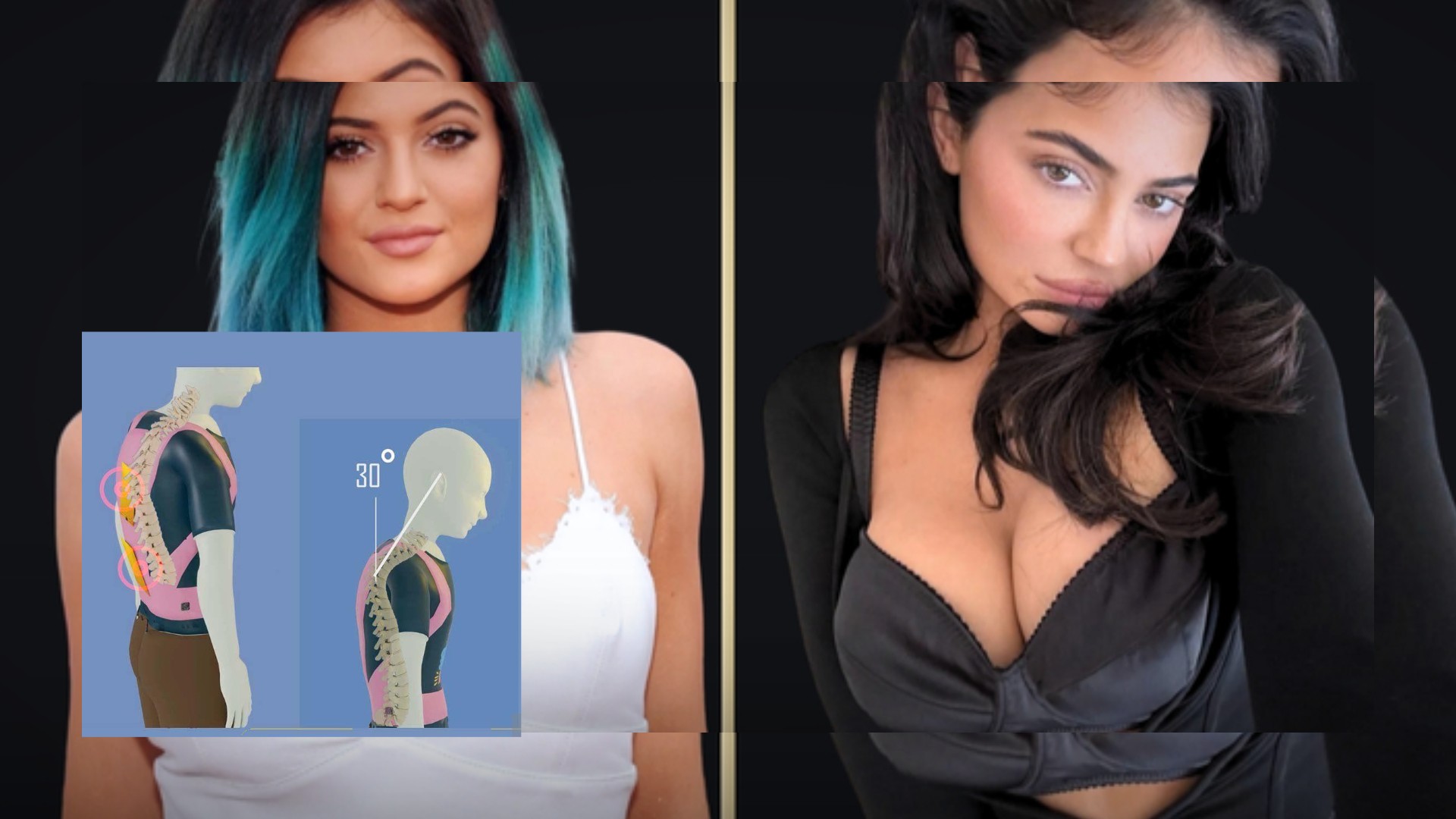 Kylie Jenner Jalani Terapi Sel Punca Mengatasi Sakit Punggung
