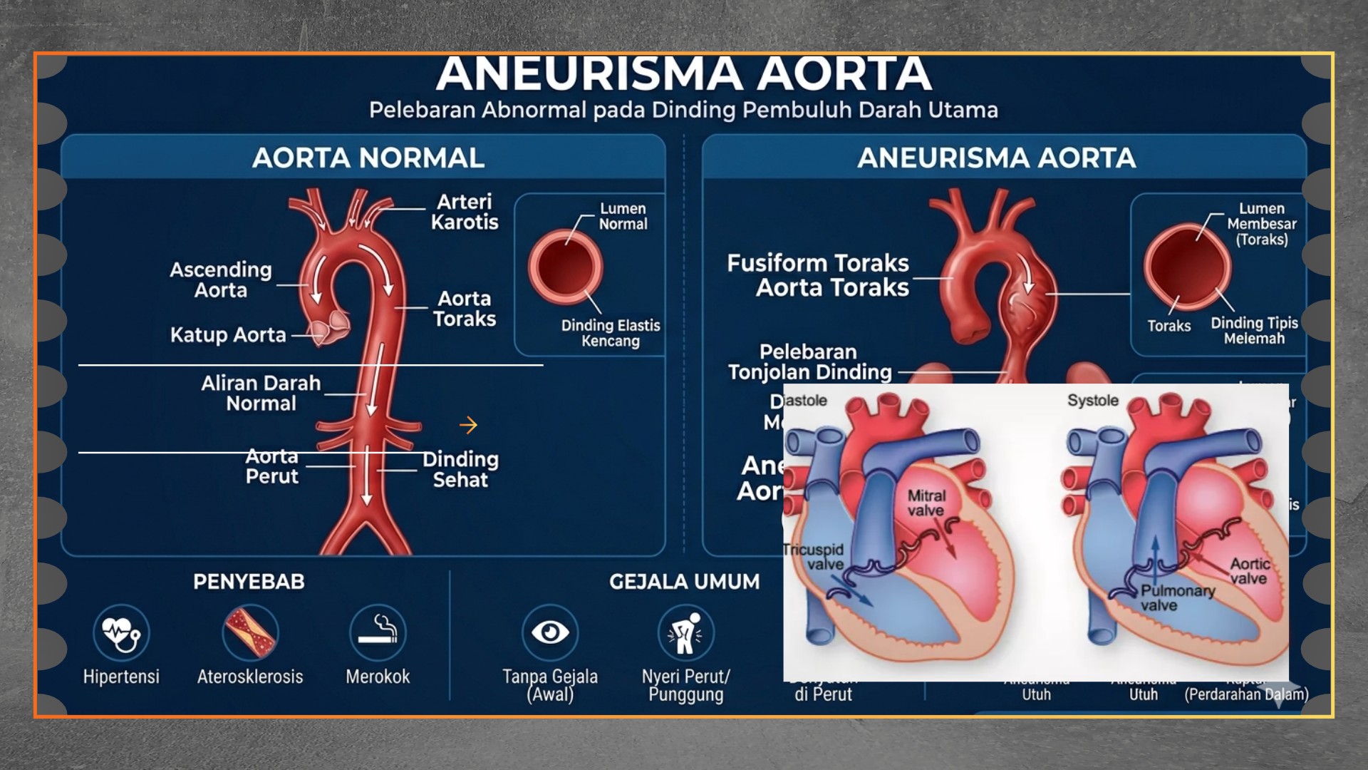 Kenali Gejala Awal Penyempitan Katup Aorta