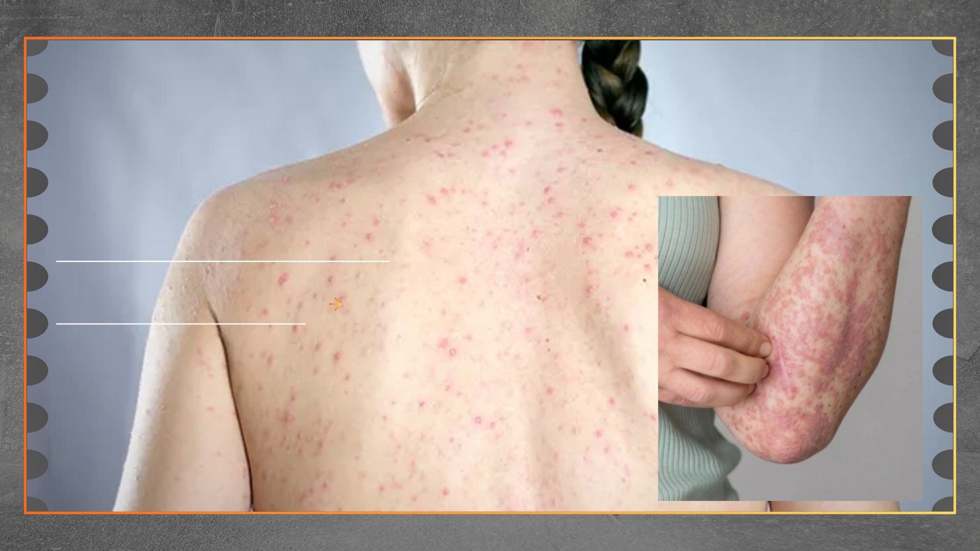 Bisakah Orang Dewasa Terkena Campak Dua Kali