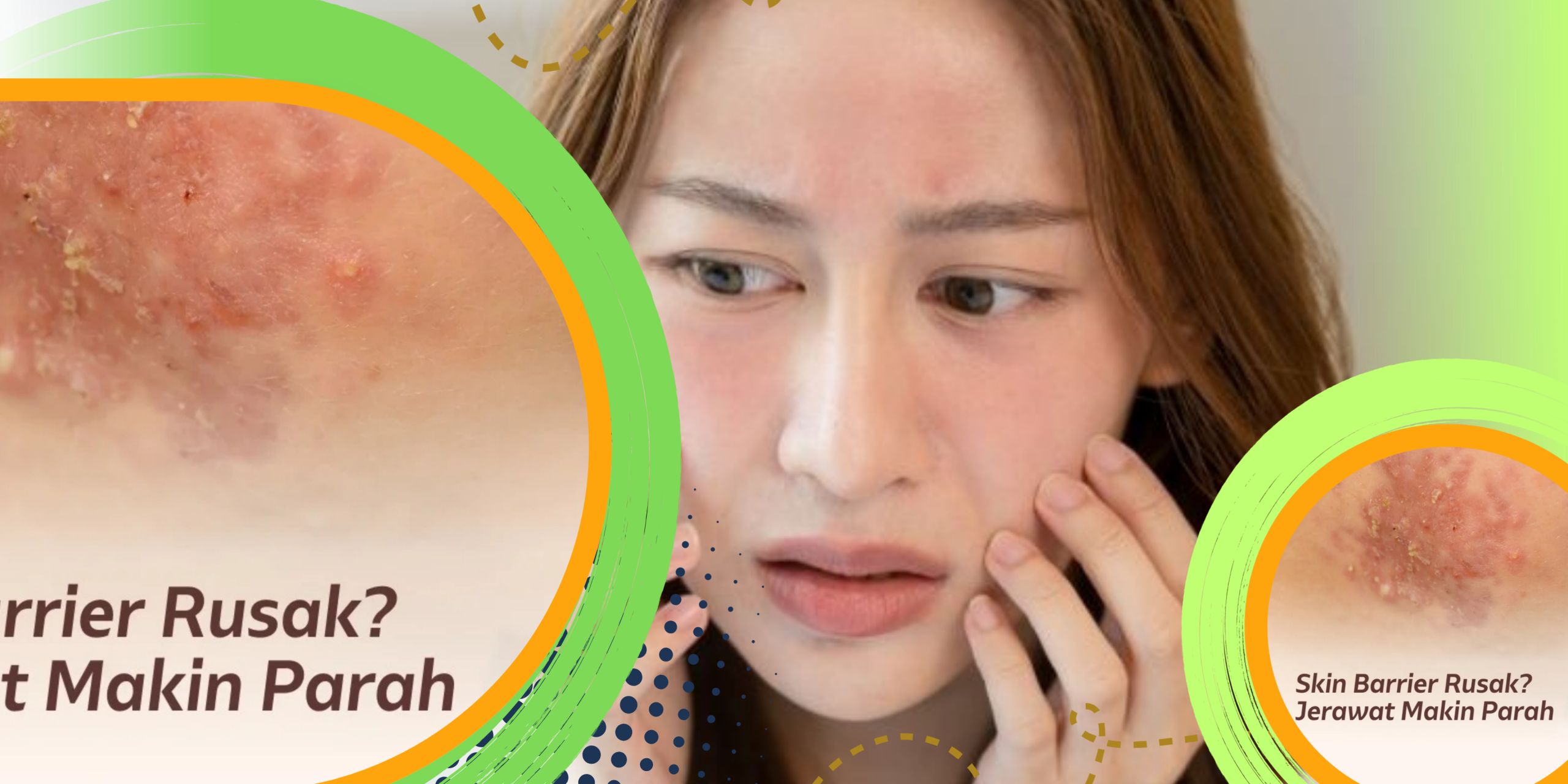Skin Barrier Rusak Bisa Picu Jerawat dan Eksim
