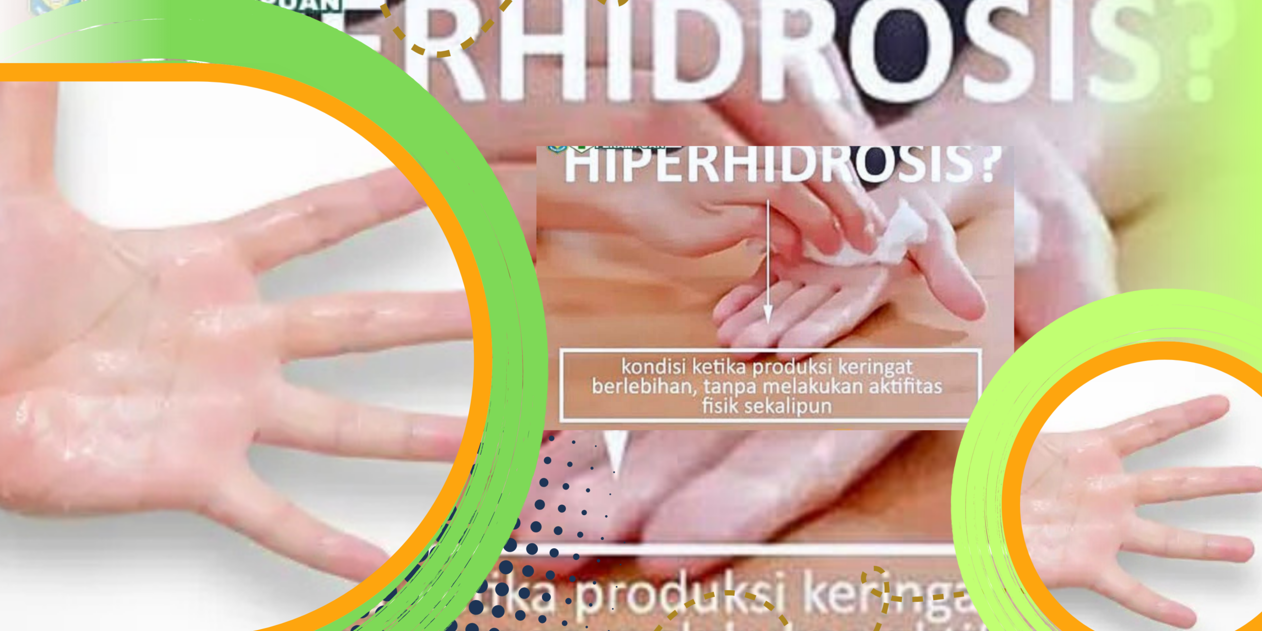 Tangan Sering Berkeringat Kenali Penyebab Hiperhidrosis